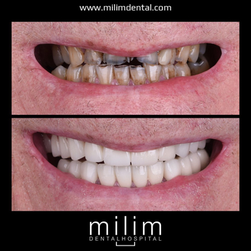 Slider image (7) Milim Dental